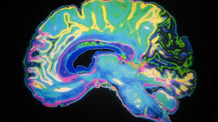 scientists train an ai to spot alzheimer’s disease six years before human diagnosis